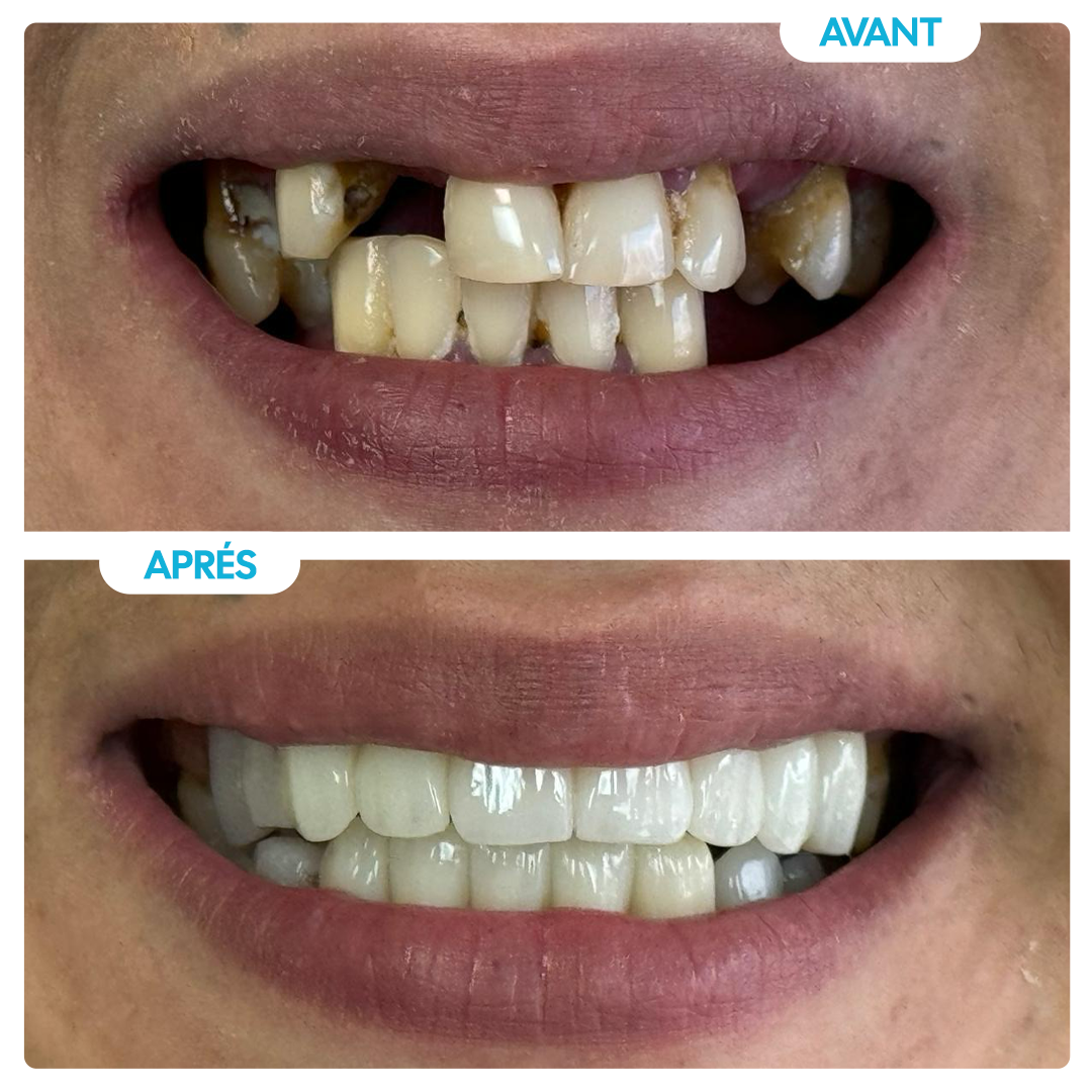 Avant / Après 1