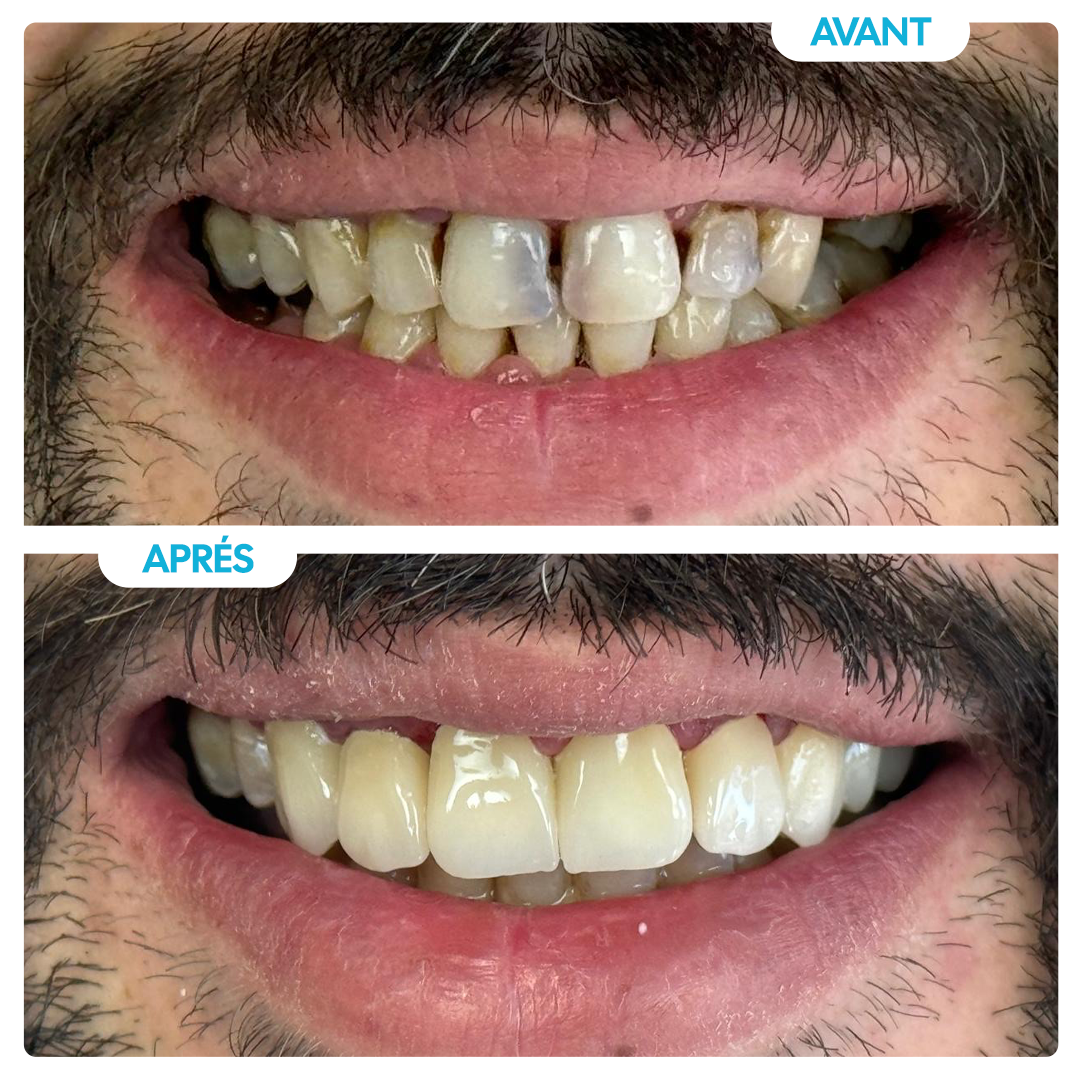 Avant / Après 2