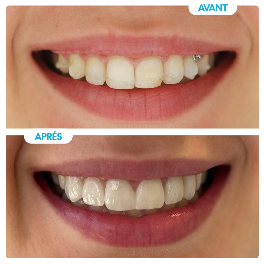 Avant / Après 6